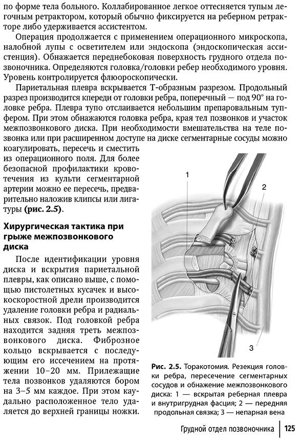 Торакотомия. Резекция головки ребра, пересечение сегментарных сосудов и обнажение межпозвонкового диска Торакотомия. Резекция головки ребра, пересечение сегментарных сосудов и обнажение межпозвонкового диска
