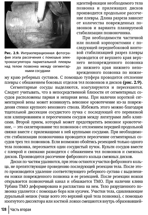 Интраоперационная фотография этапа рассечения с помошью электрокоагулятора париетальной плевры над телом позвонка между сегментарными сосудами Интраоперационная фотография этапа рассечения с помошью электрокоагулятора париетальной плевры над телом позвонка между сегментарными сосудами