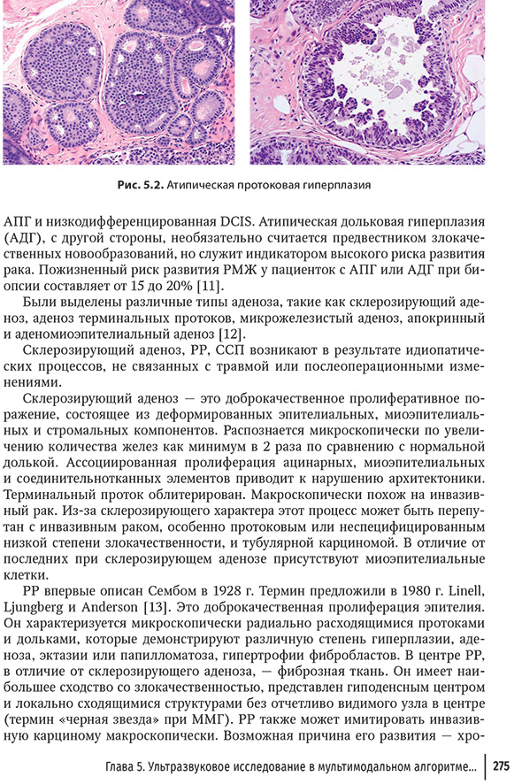 Атипическая протоковая гиперплазия