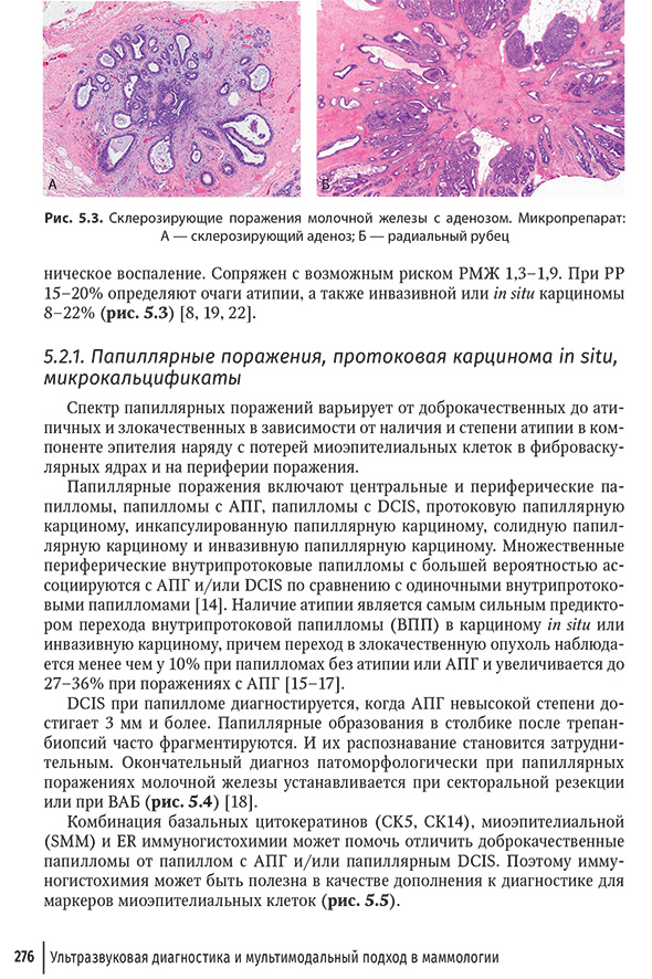 Склерозирующие поражения молочной железы с эденозом.