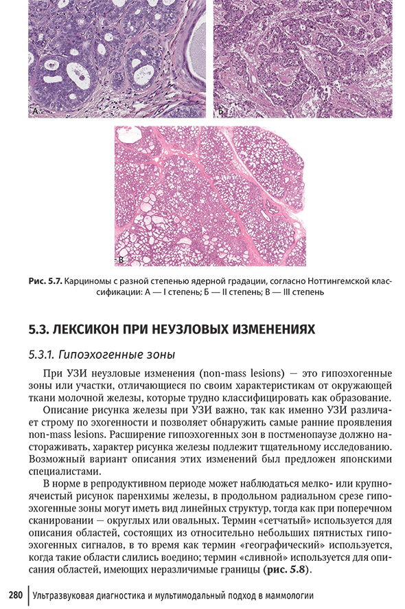 Карциномы с разной степенью ядерной градации.