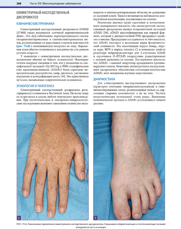 Клинические проявления симметричного наследственного дисхроматоза Клинические проявления симметричного наследственного дисхроматоза