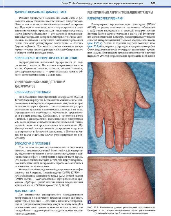 Клинические данные ретикулярной акропигментации Клинические данные ретикулярной акропигментации