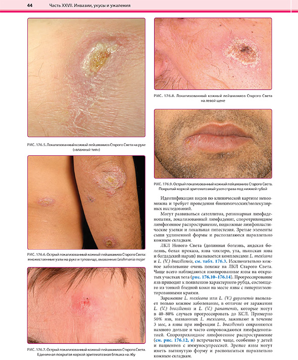 . Локализованный кожный лейшманиоз Старого Света на руке («влажный тип») . Локализованный кожный лейшманиоз Старого Света на руке («влажный тип»)