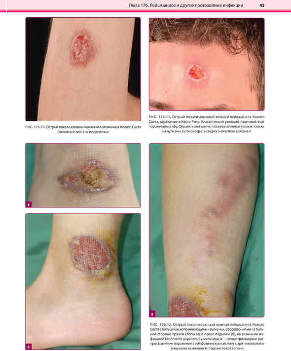 Острый локализованный кожный лейшманиоз Нового Света, Острый локализованный кожный лейшманиоз Нового Света,
