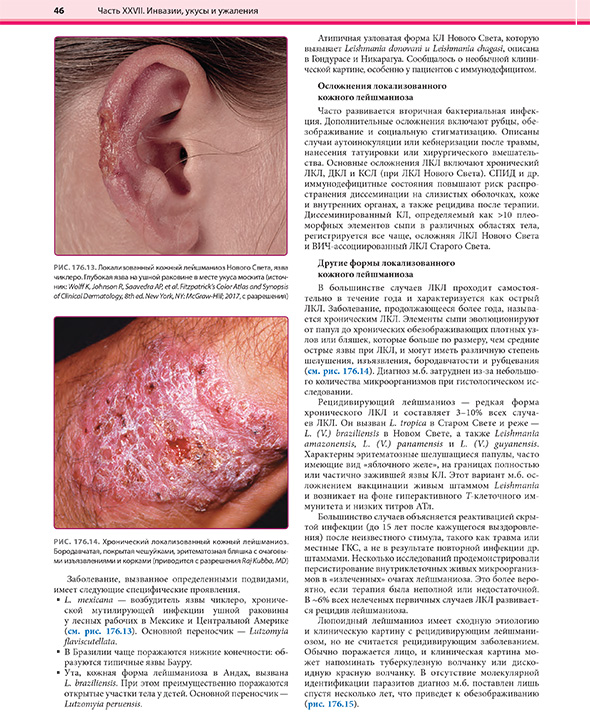 Хронический локализованный кожный лейшманиоз Хронический локализованный кожный лейшманиоз