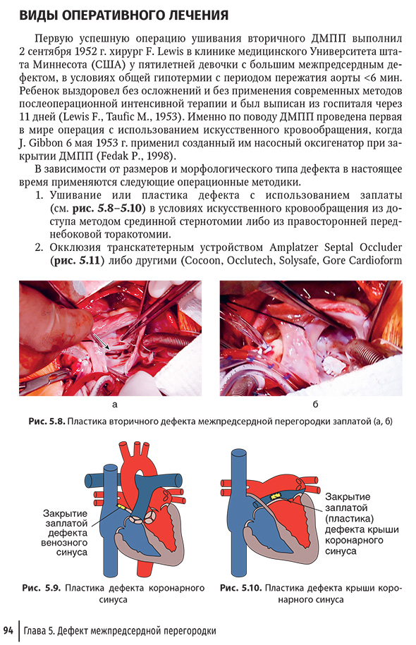 Пластика вторичного дефекта межпредсердной перегородки заплатой