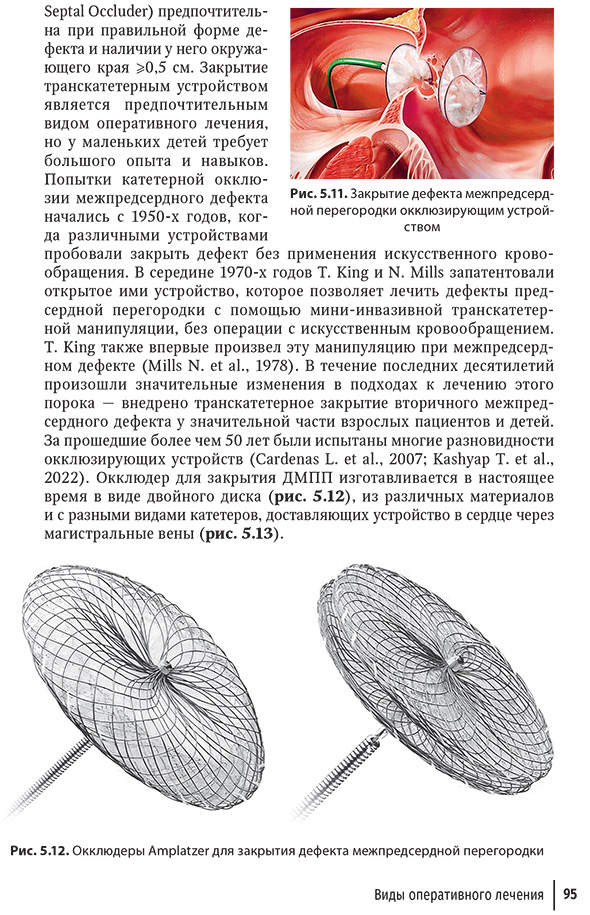 . Окклюдеры Amplatzer для закрытия дефекта межпредсердной перегородки