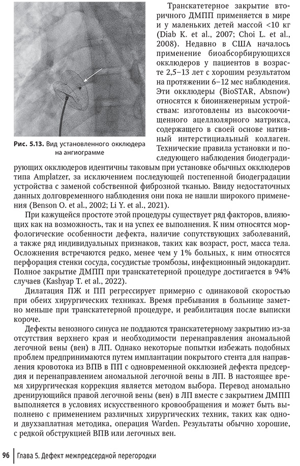 Вид установленного окклюдера на ангиограмме