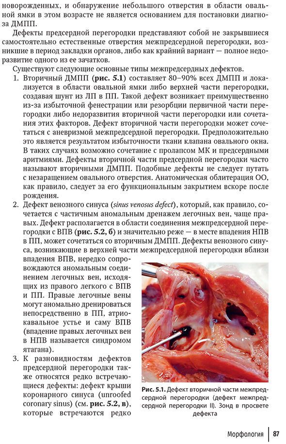 Рис. 5.1. Дефект вторичной части межпредсердной перегородки (дефект межпредсердной перегородки II). Зонд в просвете дефекта
