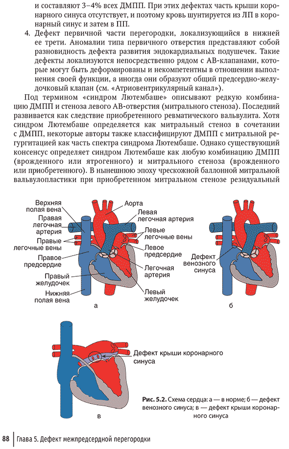 Рис. 5.2. Схема сердца: а &mdash; 8 норме; б &mdash; дефект венозного синуса; в &mdash;дефект крыши коронарного синуса