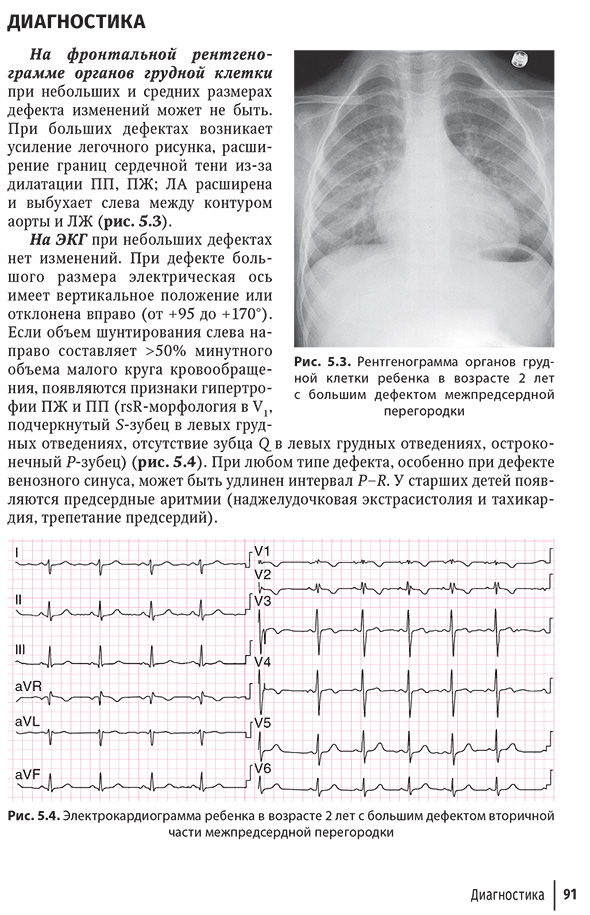 Электрокардиограмма ребенка в возрасте 2 лет с большим дефектом вторичной части межпредсердной перегородки