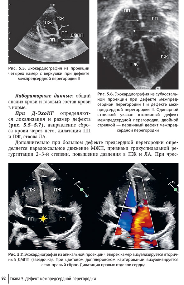 Эхокардиография из апикальной проекции четырех камер