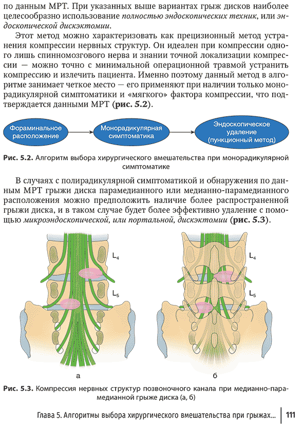 Компрессия нервных структур позвоночного канала при медианно-парамедианной грыже диска (а, б)