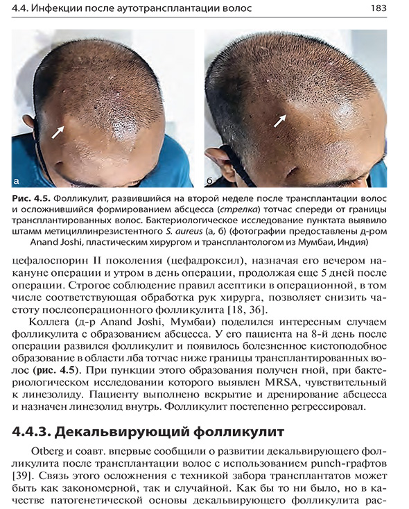 Фолликулит, развившийся на второй неделе после трансплантации волос