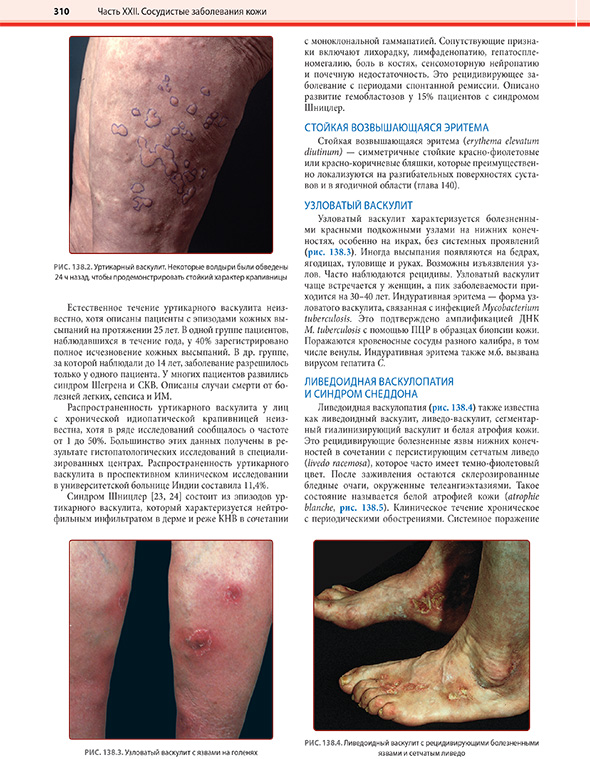 Уртикарный васкулит Уртикарный васкулит