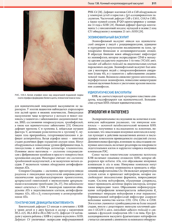 Белая атрофия кожи над медиальной лодыжкой: видны очаги атрофии фарфорово-белого цвета, телеангиэктазии и язвы Белая атрофия кожи над медиальной лодыжкой: видны очаги атрофии фарфорово-белого цвета, телеангиэктазии и язвы