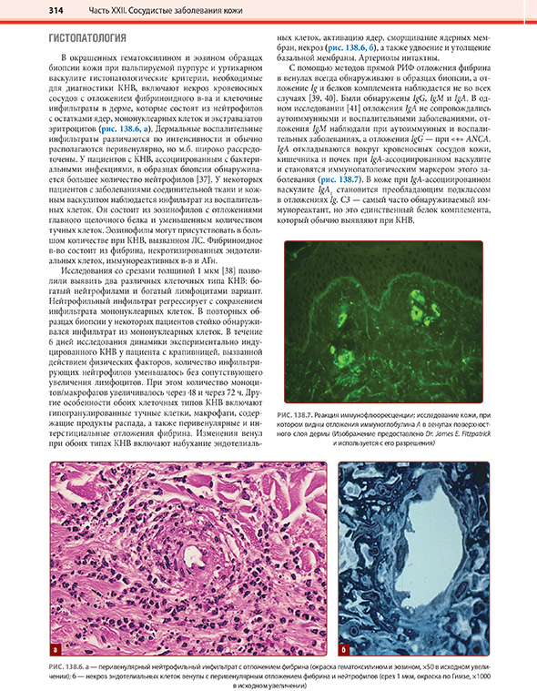 Реакция иммунофлюоресценции: исследование кожи, при котором видны отложения иммуноглобулина Реакция иммунофлюоресценции: исследование кожи, при котором видны отложения иммуноглобулина