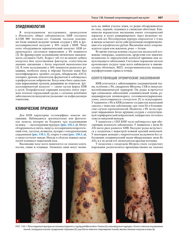 Пальпируемая пурпура на голени у пациента с пурпурой Шенлейна–Геноха Пальпируемая пурпура на голени у пациента с пурпурой Шенлейна–Геноха