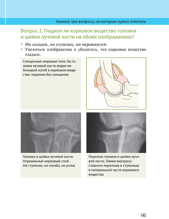 Вопрос 2. Гладкое ли корковое вещество головки и шейки лучевой кости на обоих изображениях?