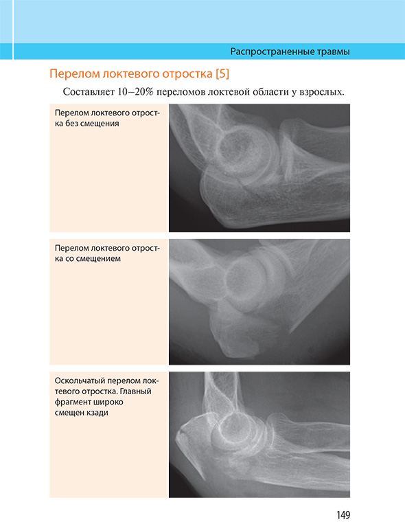 Перелом локтевого отростка