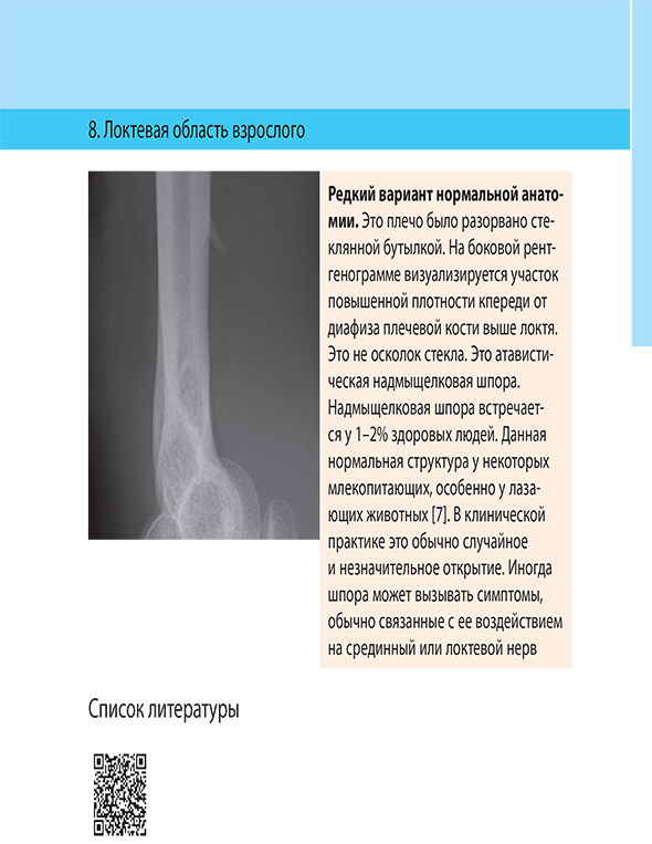 Редкий вариант нормальной анатомии. 