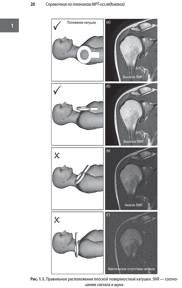 Правильное расположение плоской поверхностной катушки. SNR &mdash; соотношение сигнала и шума