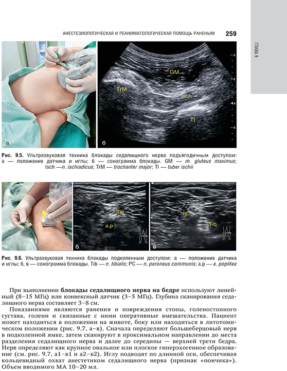 Ультразвуковая техника блокады подколенным доступом