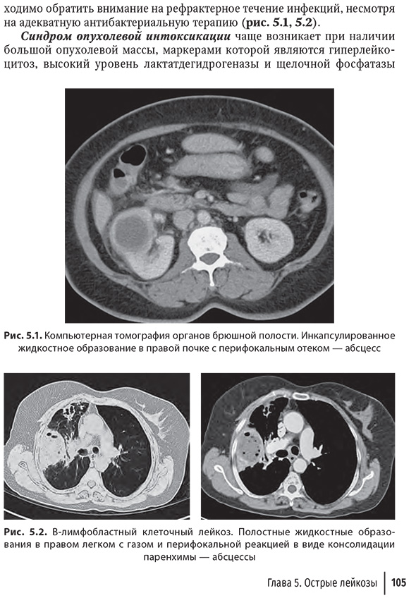 В-лимфобластный клеточный лейкоз