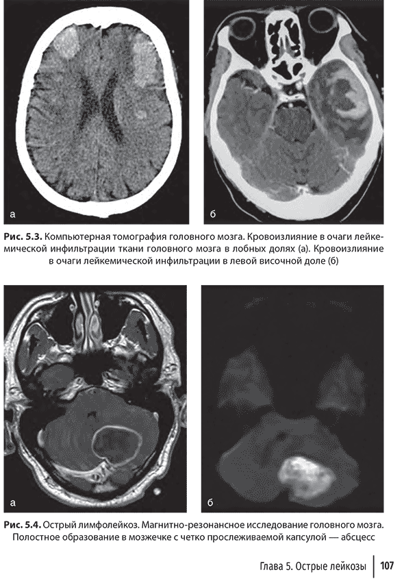 Острый лимфолейкоз. Магнитно-резонансное исследование головного мозга.