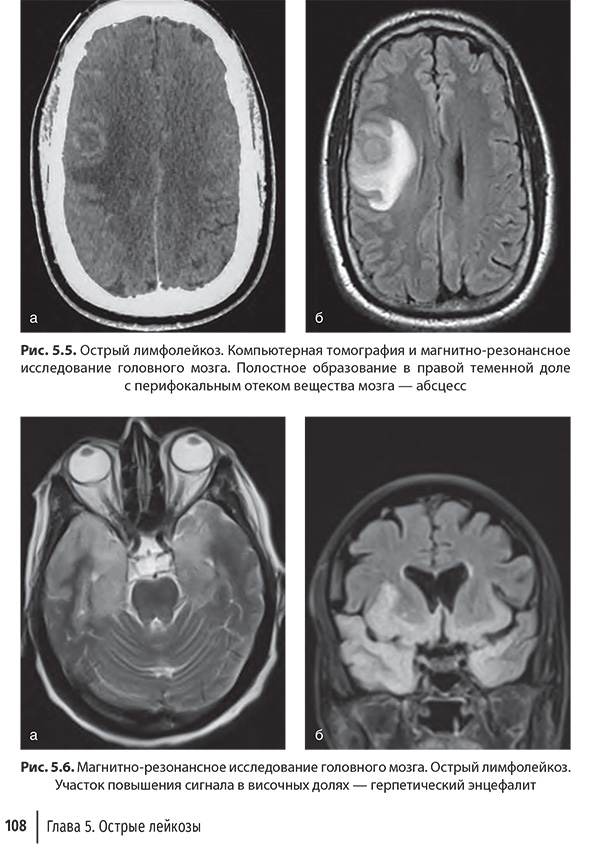 Магнитно-резонансное исследование головного мозга.