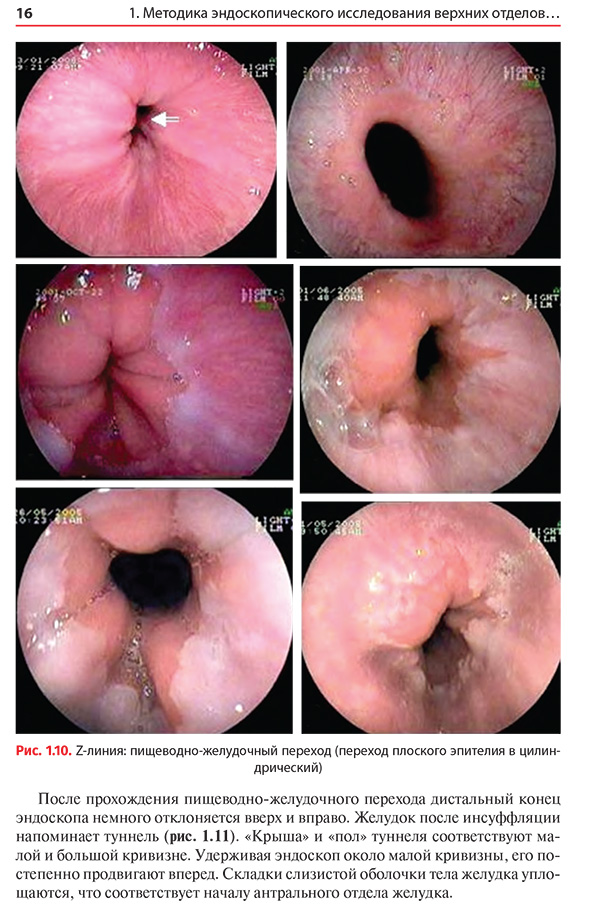 Z-линия: пищеводно-желудочный переход (переход плоского эпителия в цилиндрический)