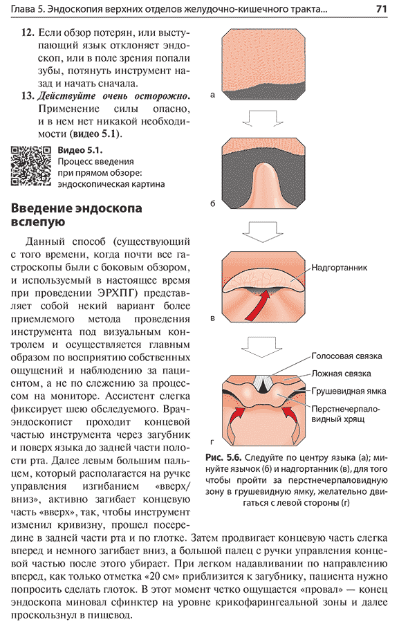 Рис. 5.6. Следуйте по центру языка (а); минуйте язычок (6) и надгортанник (в), для того чтобы пройти за перстнечерпаловидную зону в грушевидную ямку, желательно двигаться с левой стороны (г)