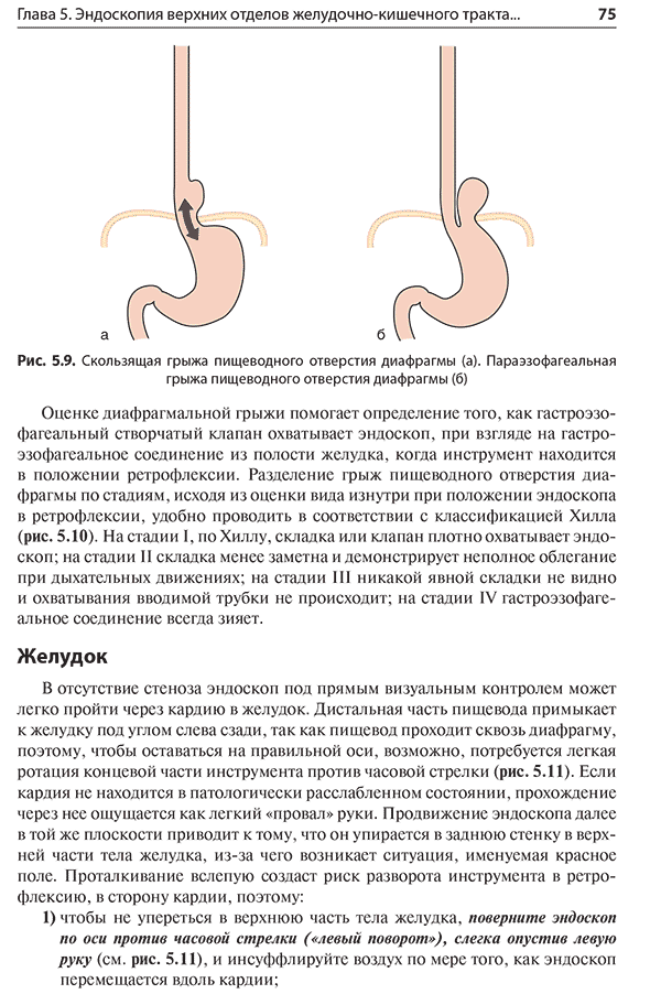 Скользящая грыжа пищеводного отверстия диафрагмы