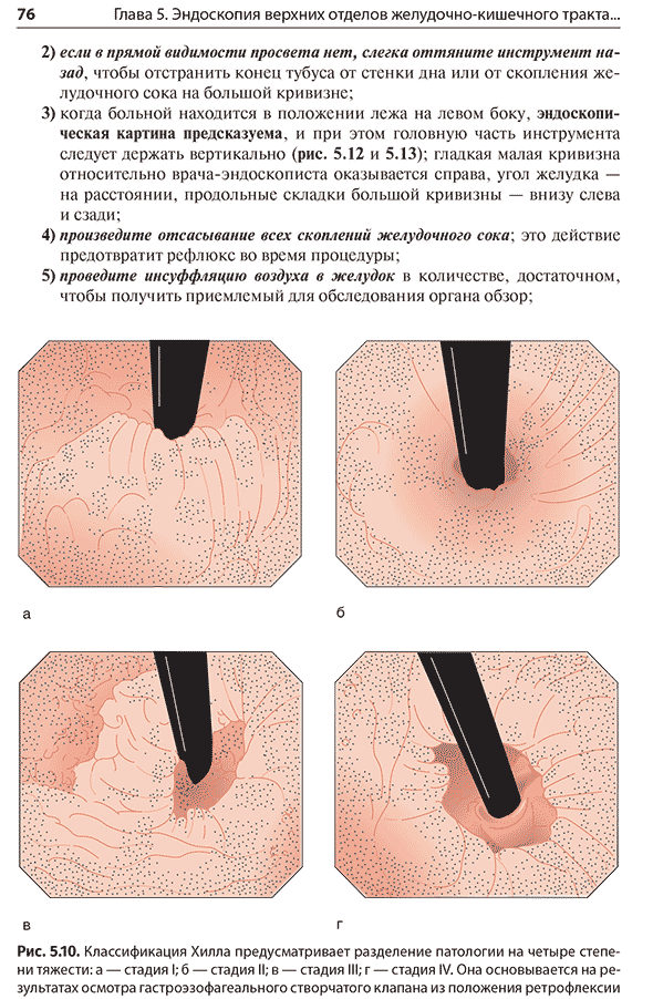 Классификация Хилла предусматривает разделение патологии