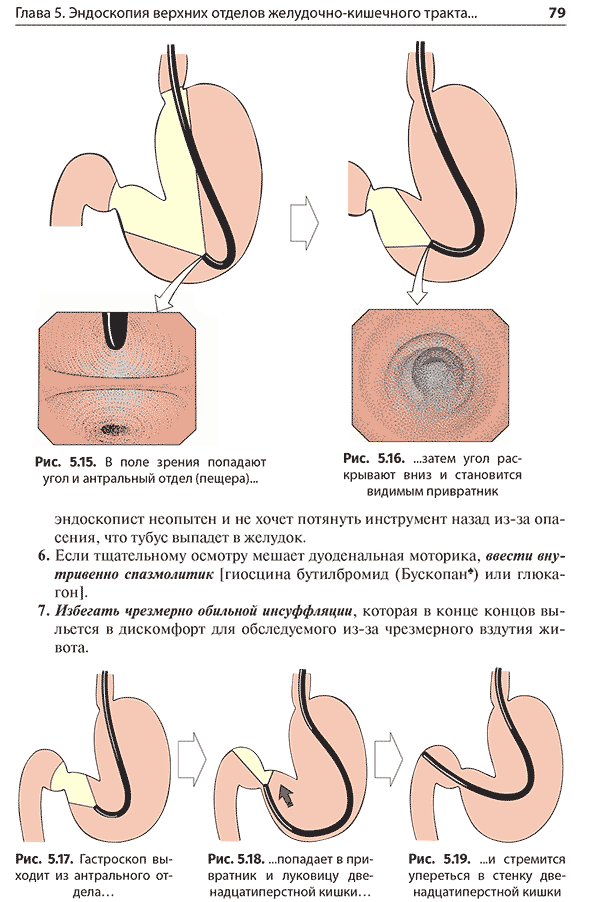 Рис. 5.15. В поле зрения попадают угол и антральный отдел (пещера)...