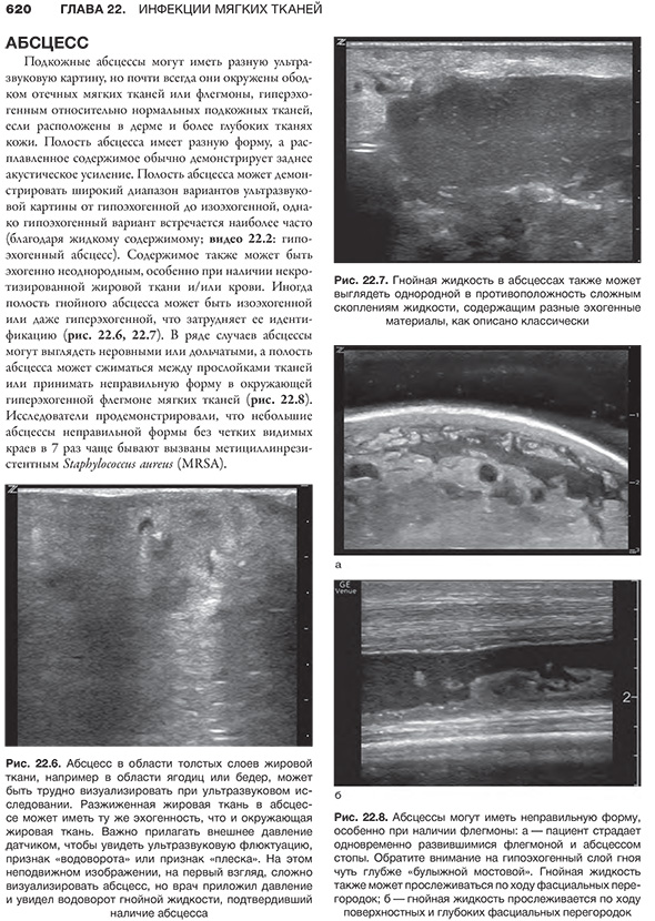 Рис. 22.7. Гнойная жидкость в абсцессах также может выглядеть однородной в противоположность сложным скоплениям жидкости, содержащим разные эхогенные материалы