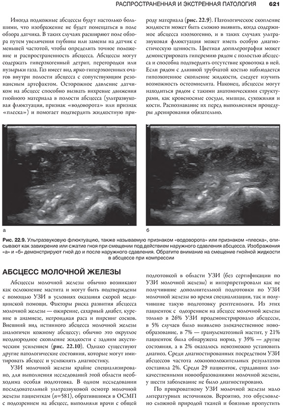 Рис. 22.9. Ультразвуковую флюктуацию, также называемую признаком "водоворота" или признаком "плеска".