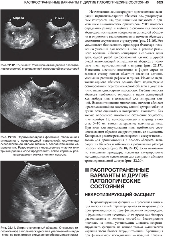 Рис. 22.12. Тонзиллит. Увеличенная миндалина слева (головки стрелок) с сохраненной однородной эхотекстурой