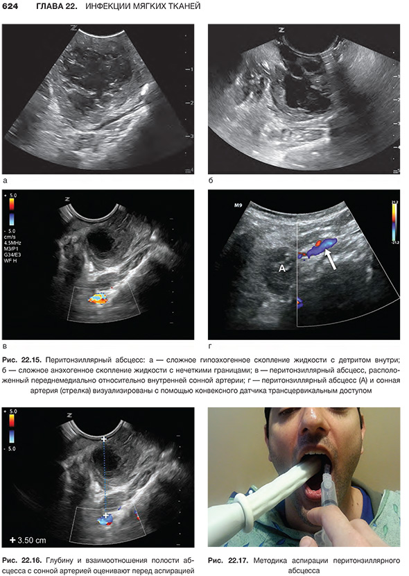 Перитонзиллярный абсцесс