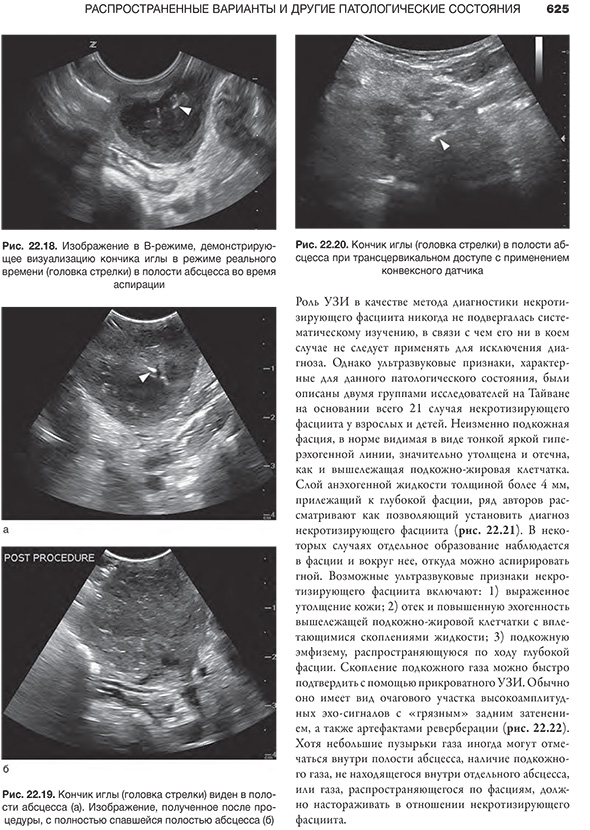 Рис. 22.20. Кончик иглы (головка стрелки) в полости абсцесса при трансцервикальном доступе с применением конвексного датчика