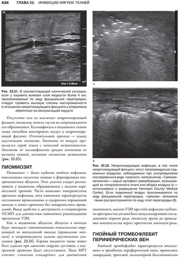 Рис. 22.21. В соответствующей клинической ситуации, если у пациента выявлен слой жидкости более 4 мм.