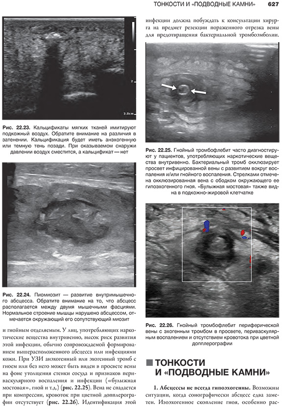 Рис. 22.23. Кальцификаты мягких тканей имитируют подкожный воздух. Обратите внимание на различия в затенении.