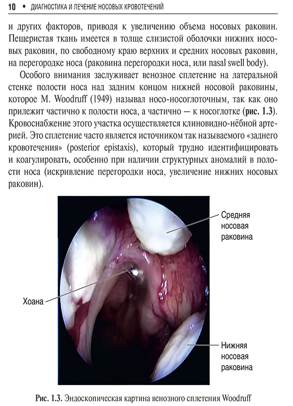 Эндоскопическая картина венозного сплетения Woodruff Эндоскопическая картина венозного сплетения Woodruff