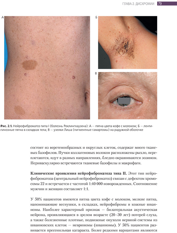 Нейрофиброматоз типа 1 Нейрофиброматоз типа 1