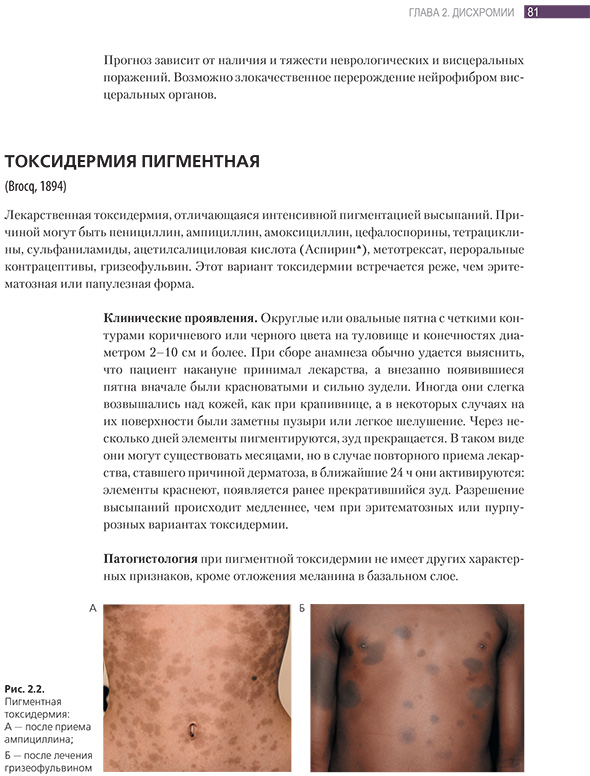Пигментная токсидермия Пигментная токсидермия