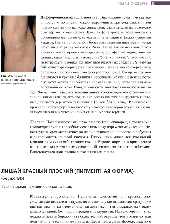 Множественная идиопатическая пигментация кожи Множественная идиопатическая пигментация кожи