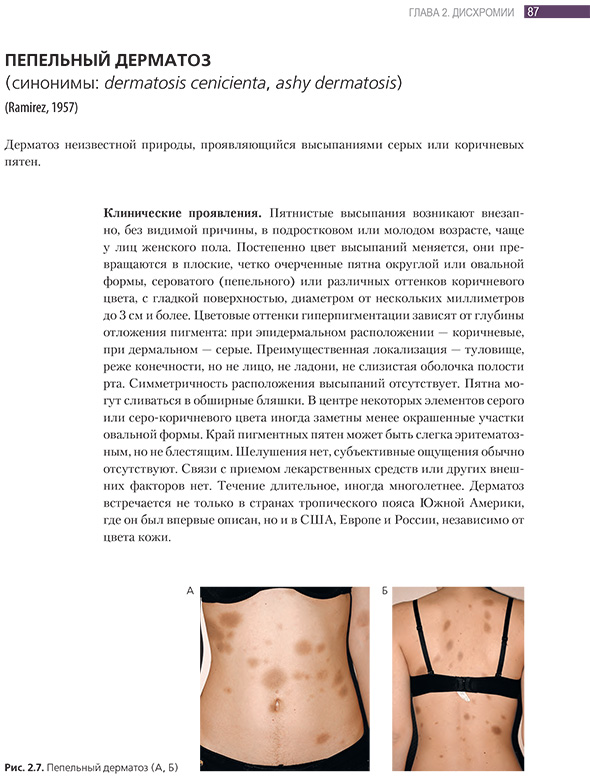 Пепельный дерматоз Пепельный дерматоз