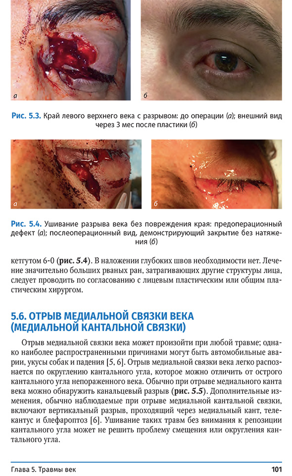 Ушивание разрыва века без повреждения края