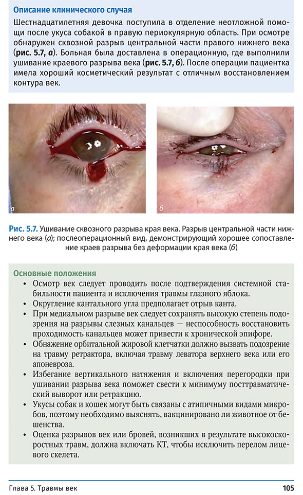 Ушивание сквозного разрыва края века.